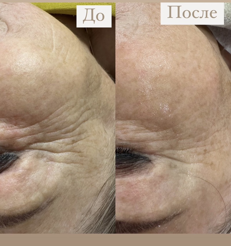 Смотрите, какая акция: чистка лица, пилинги, уходовые процедуры по типу ...